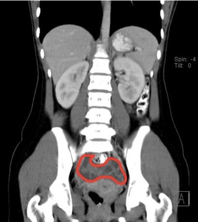▲▼電腦斷層影像顯示子宮後方有不規則腫塊。（圖／國泰醫院提供）
