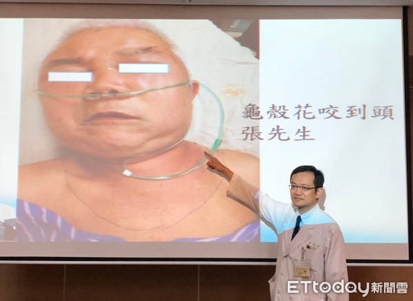 半夜上廁所遭「天降龜殼花」咬頭皮　他呼吸衰竭險沒命。（圖／記者嚴云岑攝）