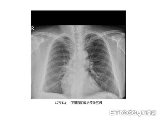 ▲患者罹罕見間質性肺炎，經使用類固醇治療才得以痊癒。（圖／記者林悅翻攝）