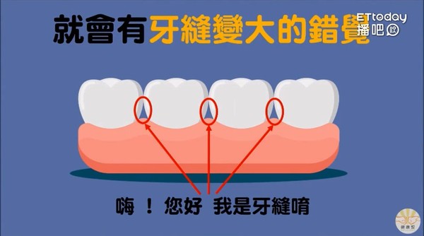 ▲洗牙。（圖／健康盟健康聯盟）