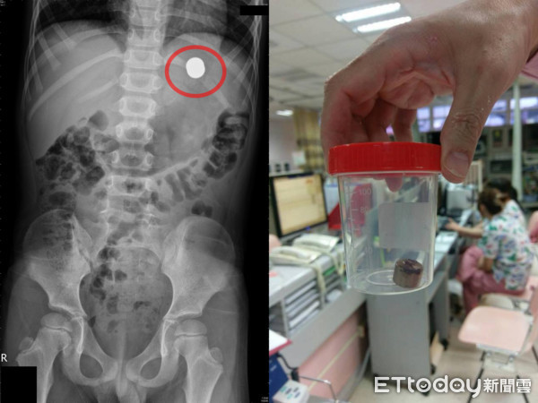 ▲我兒子是萬磁王？6歲童腹部吸磁鐵　醫揪出「爆笑真相」。（圖／「來講兒童急診543」吳昌騰醫師提供，請勿隨意翻拍，以免侵權。）