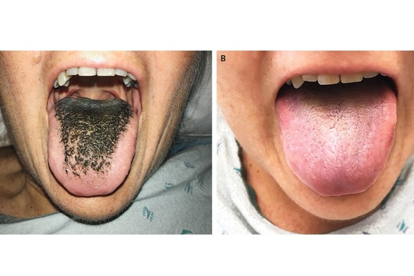 ▲▼美國婦人因為服用抗生素，舌頭長出黑毛。（圖／翻攝自新英格蘭醫學雜誌網站）