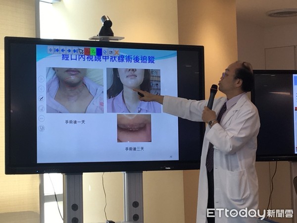 ▲經口切甲狀腺不留疤　北榮更首創「安全裝置」避免下巴麻。（圖／記者嚴云岑攝）