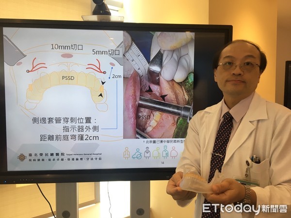 ▲經口切甲狀腺不留疤　北榮更首創「安全裝置」避免下巴麻。（圖／記者嚴云岑攝）