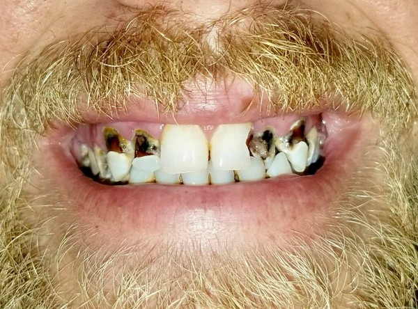 美國牙醫承諾幫網友免費補牙，1年後真的實現了。（圖／翻攝自Facebook／Kenny Wilstead）