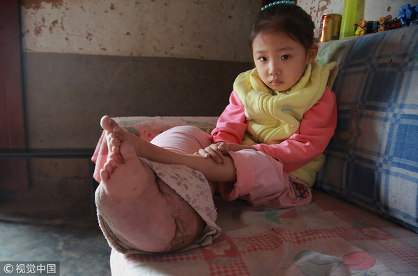 5歲女童血管瘤腿腫如象腿，太窮只能在家等死。（圖／CFP）