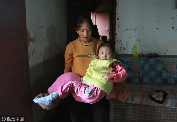 5歲女童血管瘤腿腫如象腿，太窮只能在家等死。（圖／CFP）