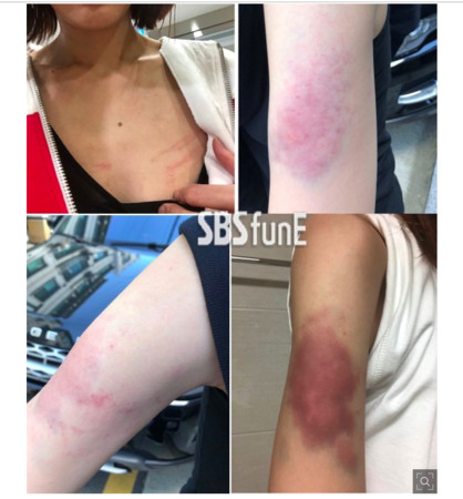 ▲姜成勳身邊的女性也公開自己受傷的照片。（圖／翻攝自SBS Fune）
