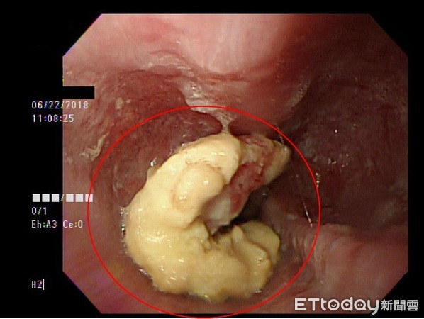 ▲▼連水都喝不下！7公分腫瘤卡食道...他爆瘦10公斤罹癌3期。（圖／亞洲大學附屬醫院提供）