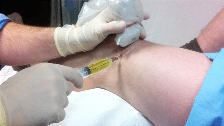 膝關節積水又腫又痠痛掌握4大原則治療效果才會好 Ettoday探索 Ettoday新聞雲 膝關節積水又腫又痠痛掌握4大原則治療效果才會好 Ettoday探索 Ettoday新聞雲