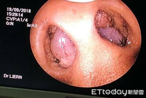 ▲鼻竇炎蓄膿「息肉比手掌大」　醫用這技術助斐濟男正常呼吸。（圖／記者嚴云岑攝）