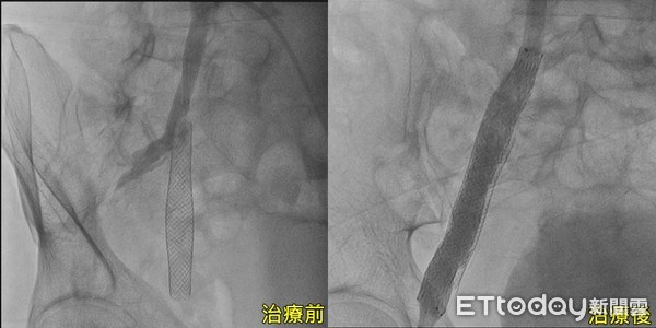 ▲▼亞大醫院心臟血管外科主任替患者檢查下肢靜脈狀況。（圖／非當事人／亞大醫院提供）