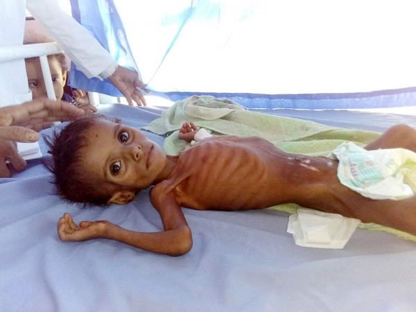 ▲▼葉門內戰導致許多孩童饑荒而亡。（圖／達志影像／美聯社）