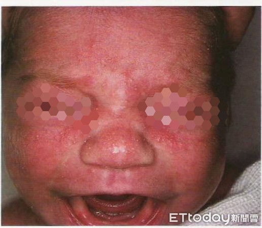 ▲台南市立安南醫院兒科賴以修醫師表示嬰孩脂漏性皮膚炎，這是一個很常見的皮膚病兆，家長可請兒科醫師幫忙解決寶寶皮膚問題。（圖／安南醫院提供，下同）