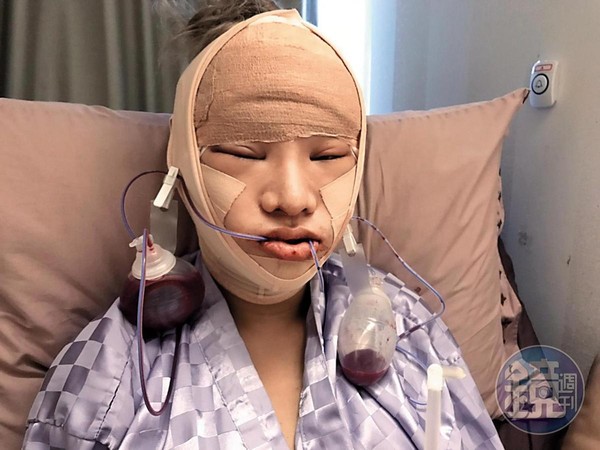 剛動完臉部手術後，小A辣幾乎包成木乃伊，休息3個月不能露臉。（小A辣提供）