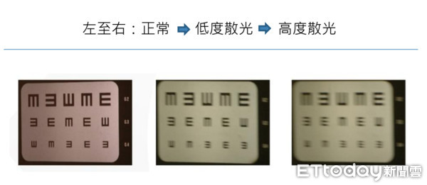 ▲白內障近視飆600度　開車視力「日全蝕」險失明。（圖／公關提供）