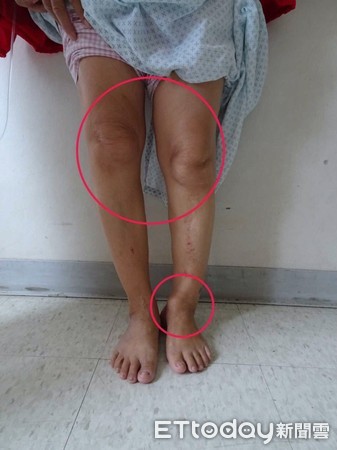 ▲65歲張媽媽（中）歷經一年來踝關節矯正及融合、小腿骨延長及矯正後，終於擺脫長短腳之苦，可以放心走路不喊痛。（圖／台東基督教醫院提供，下同）