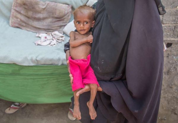 葉門有許多患有急性營養不良的兒童。（圖／翻攝自Save the Children）