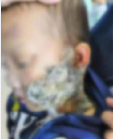 ▲▼3歲男童面部燙傷，長輩誤信偏方將貓毛敷在傷口上。（圖／翻攝自梨視頻）