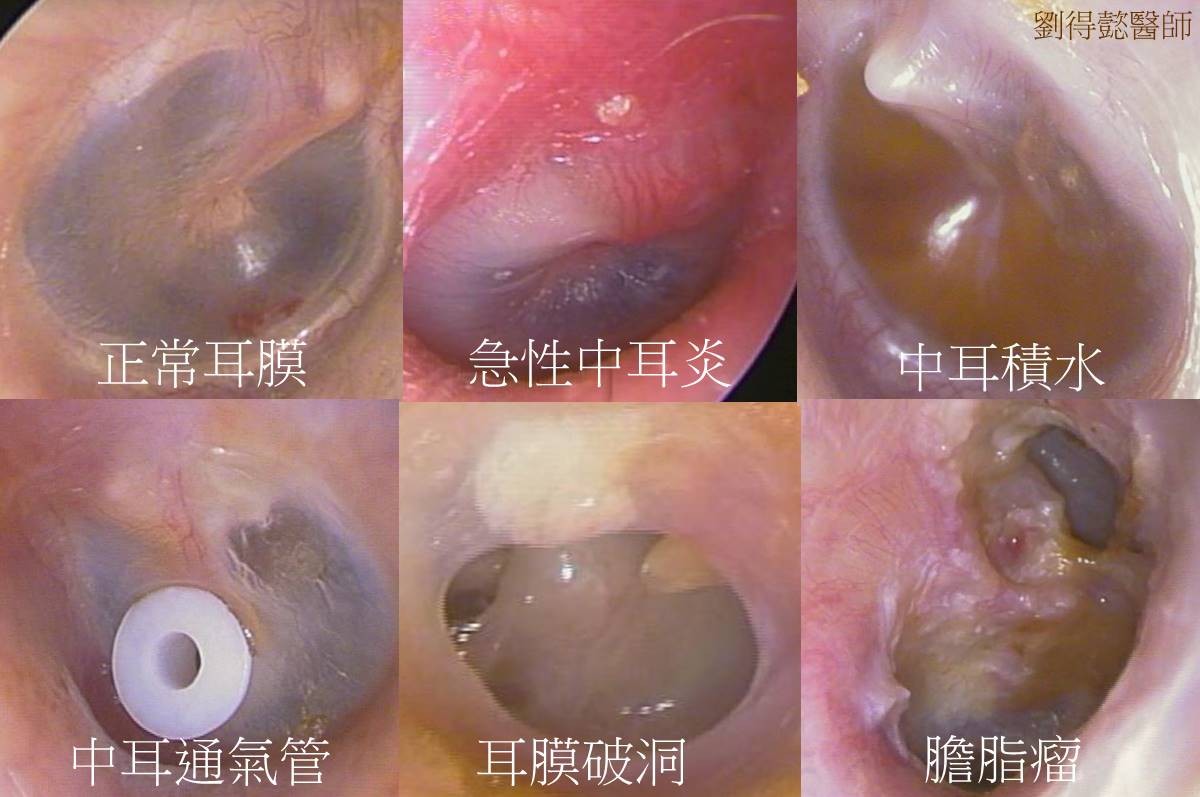 不要輕忽中耳炎常見問題一次解答 Ettoday探索 Ettoday新聞雲