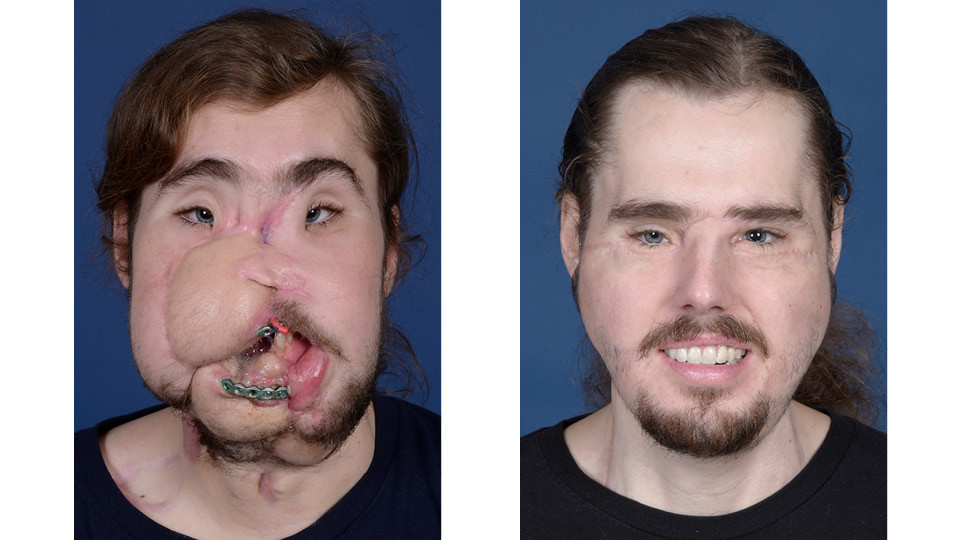 ▲▼卡梅隆（Cameron Underwood）面部移植前後變化。（圖／翻攝自紐約大學朗格健康醫院）