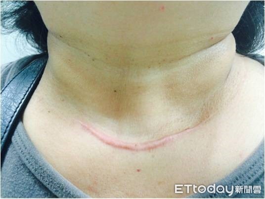 ▲▼甲狀腺結節。（圖／童綜合醫院提供）
