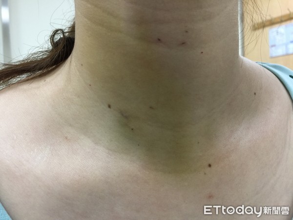 ▲▼甲狀腺結節。（圖／童綜合醫院提供）