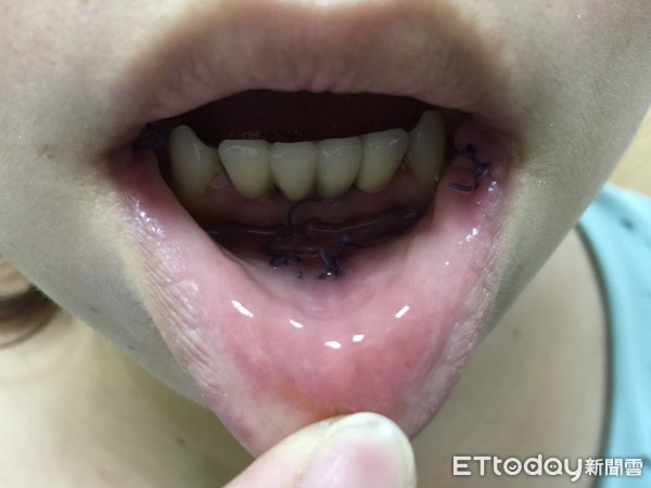 ▲▼甲狀腺結節。（圖／童綜合醫院提供）