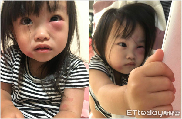 ▲1個月被蚊子虐3次！2歲妹萌眼爆腫。（圖／洪湘茵授權引用）