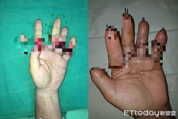 女DIY噴血秒斷！左手拎右手掌求救。（圖／黃書鴻醫師提供）
