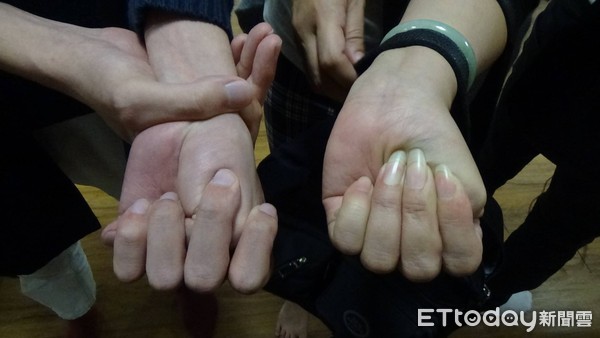 ▲▼姆指向內握拳超出小指的人（左），就有可能馬凡氏症候群，容易發生主動脈剝離。（圖／記者陳玉翻攝）
