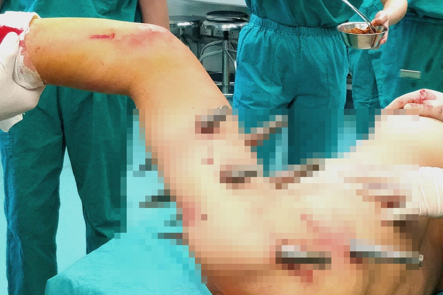 ▲湖南工人被機械手臂砸到，右半身被鋼釘刺穿。（圖／翻攝自人民網）