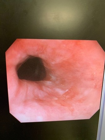 ▲早期食道癌。（圖／盧柏文醫師提供）