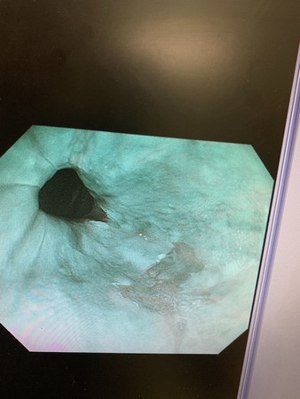 ▲早期食道癌。（圖／盧柏文醫師提供）