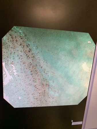 ▲早期食道癌。（圖／盧柏文醫師提供）