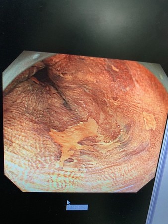 ▲早期食道癌。（圖／盧柏文醫師提供）