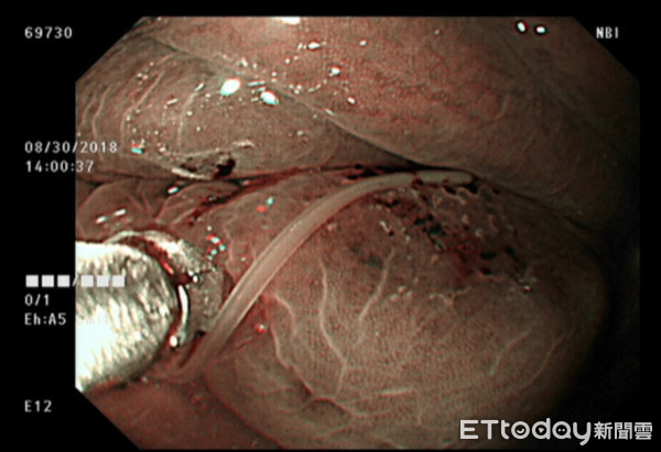 ▲她吃完海鮮野味腹劇痛　「活蟲死死咬住胃壁不肯鬆口」。（圖／台安醫院提供）