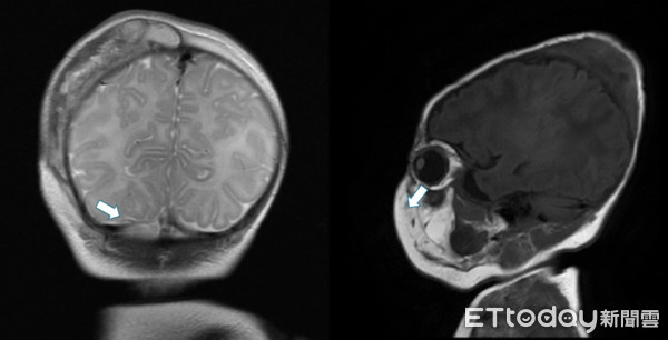 ▲新生兒血腫別亂揉！。（圖／中國附醫提供）