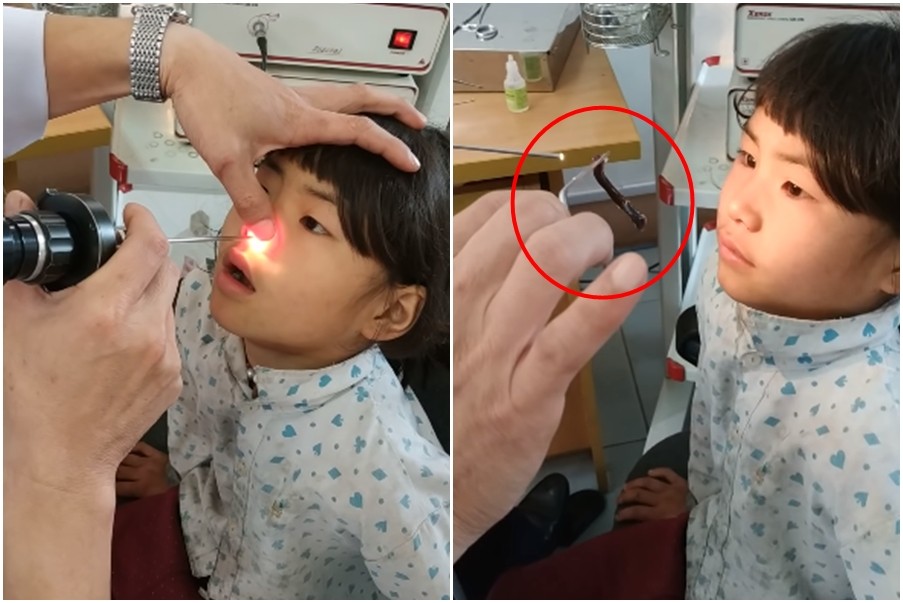 ▲越南一名小女孩鼻腔內竟然藏有肥大水蛭。（圖／翻攝自YouTube）