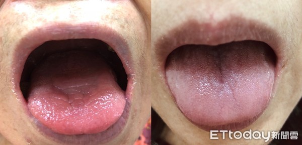 ▲▼乾燥症,舌頭。（圖／亞大醫院提供）