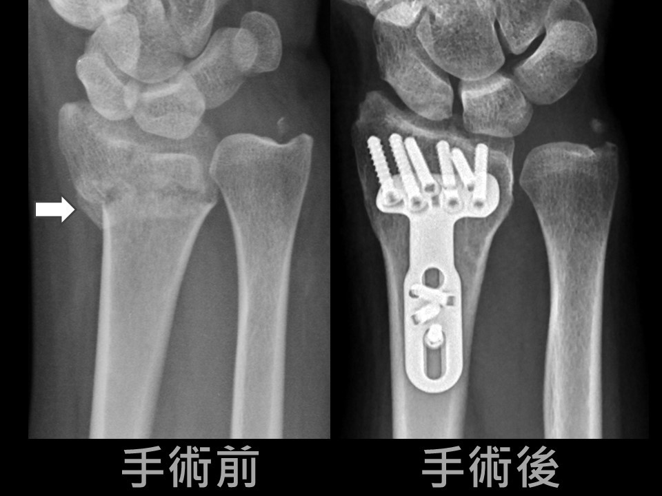 术前术后病友桡骨正面x光照片(箭头为骨折处.
