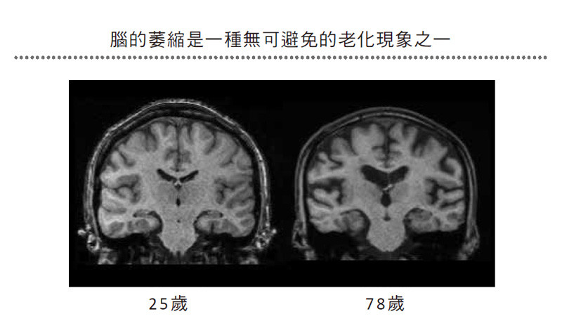 ▲腦萎縮  。（圖／悅知文化提供）