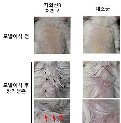 ▲▼南韓,首爾大學醫院,毛髮移植（圖／翻攝自首爾大學醫院）