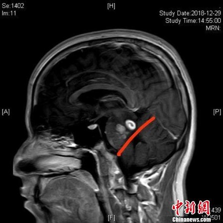 ▲圖為患者頭部核磁共振影像，紅色標記線上方的白色區域為寄生蟲。（圖／翻攝自中新網）