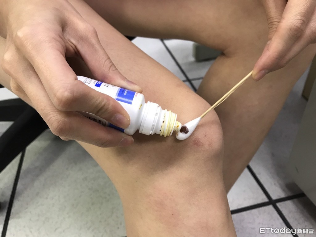 塗液體OK繃「像酷刑」 網教先塗藥膏!醫曝正解打臉:完全沒效