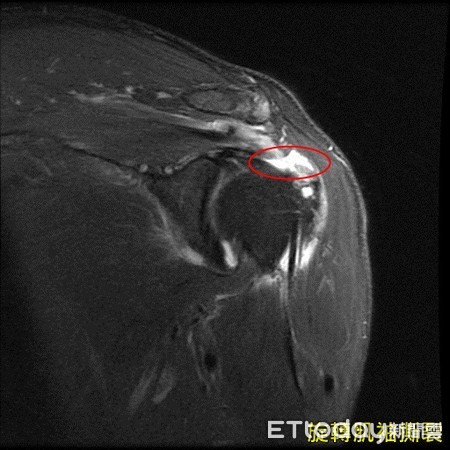 ▲婦肩痛 「連煎蛋都會痛」，原來是旋轉肌袖撕裂作祟。（圖／記者陳玉翻攝）
