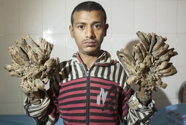▲▼孟加拉男子患罕見疾病，雙手肉疣如樹枝。（圖／新華社）