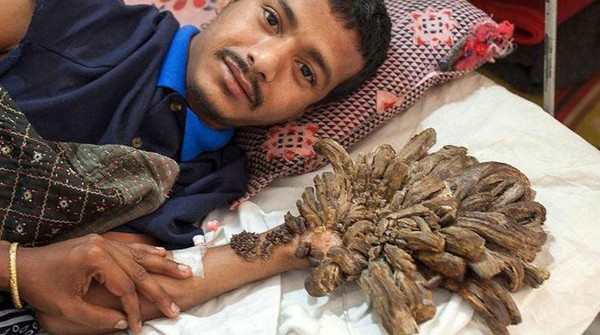 ▲▼孟加拉男子患罕見疾病。（圖／翻攝自SBS NITV）