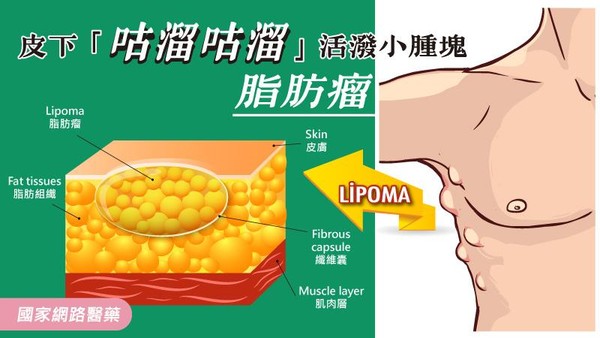 ▲▼脂肪瘤。（圖／kingnet國家網路醫藥提供）