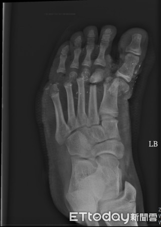 ▲▼男童左腳掌5腳趾全斷，經馬拉松手術接回，免於截肢。（圖／梧棲童綜合醫院提供）
